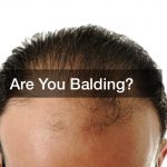 Are You Balding?